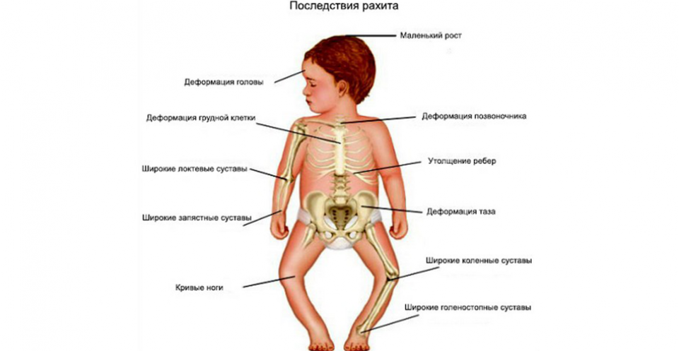 Профилактика и лечение рахита у ребенка